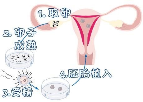 志愿者借卵代孕咨询怎么收费